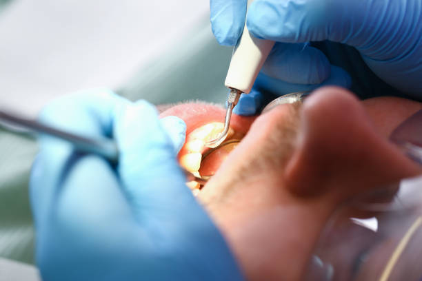 Best Emergency Wisdom Tooth Extraction in Hardwick, GA
